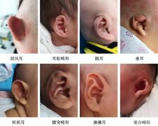 重庆人工耳蜗补贴优惠